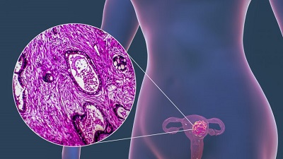Projeto prevê exame genético para o diagnóstico de HPV pelo SUS